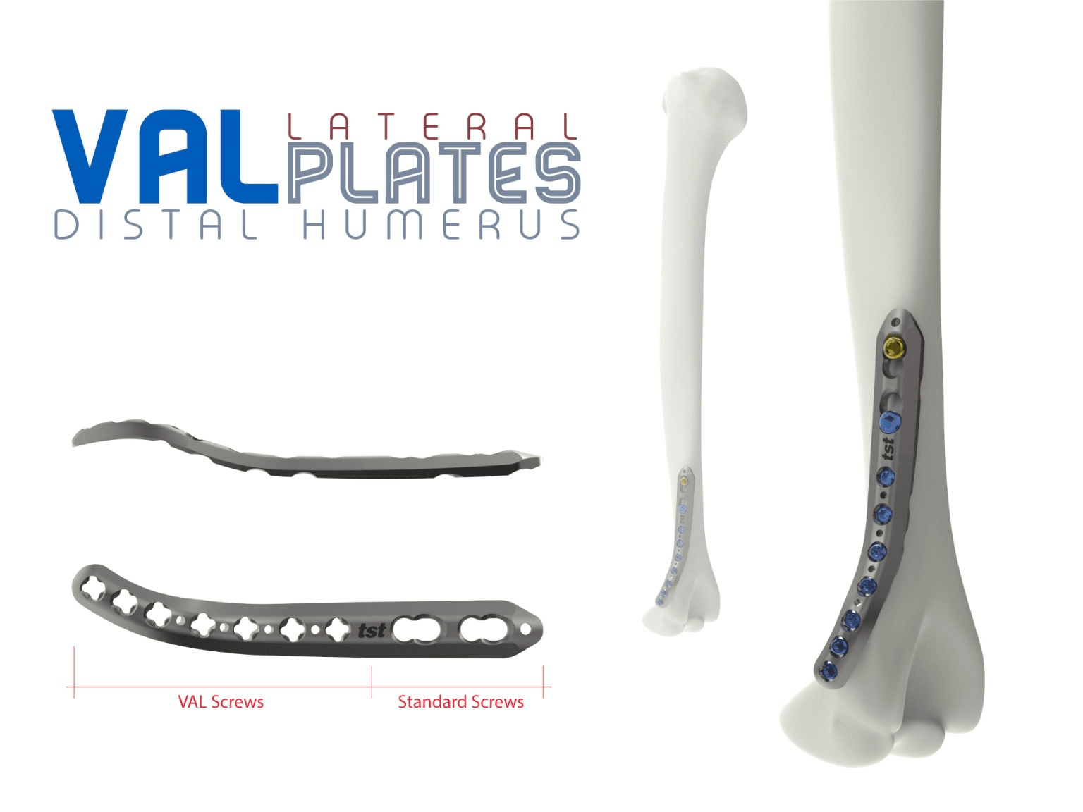 Distal Humerus Lateral Anatomical Plates